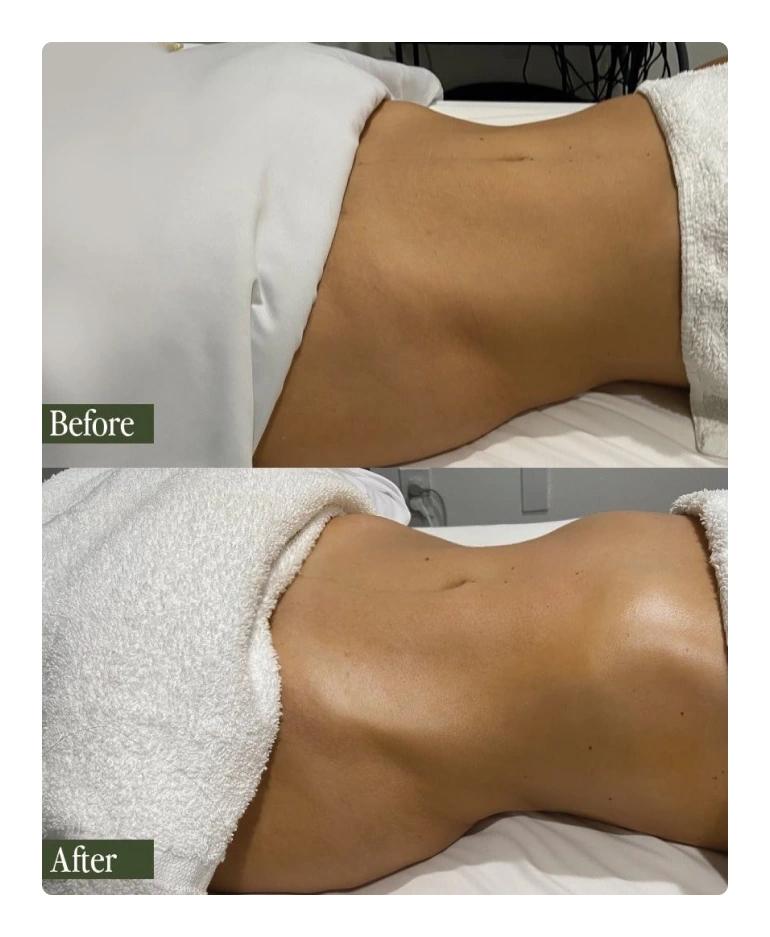Results of Lymphatic Drainage Massage